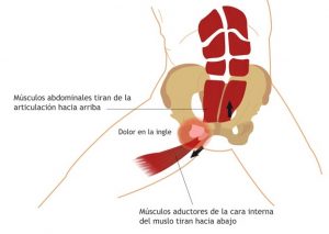 lesion-atleta-pubalgia