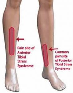shin_splints3