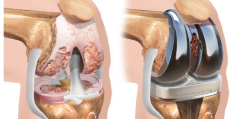 artroplastia de rodilla rehabilitacion